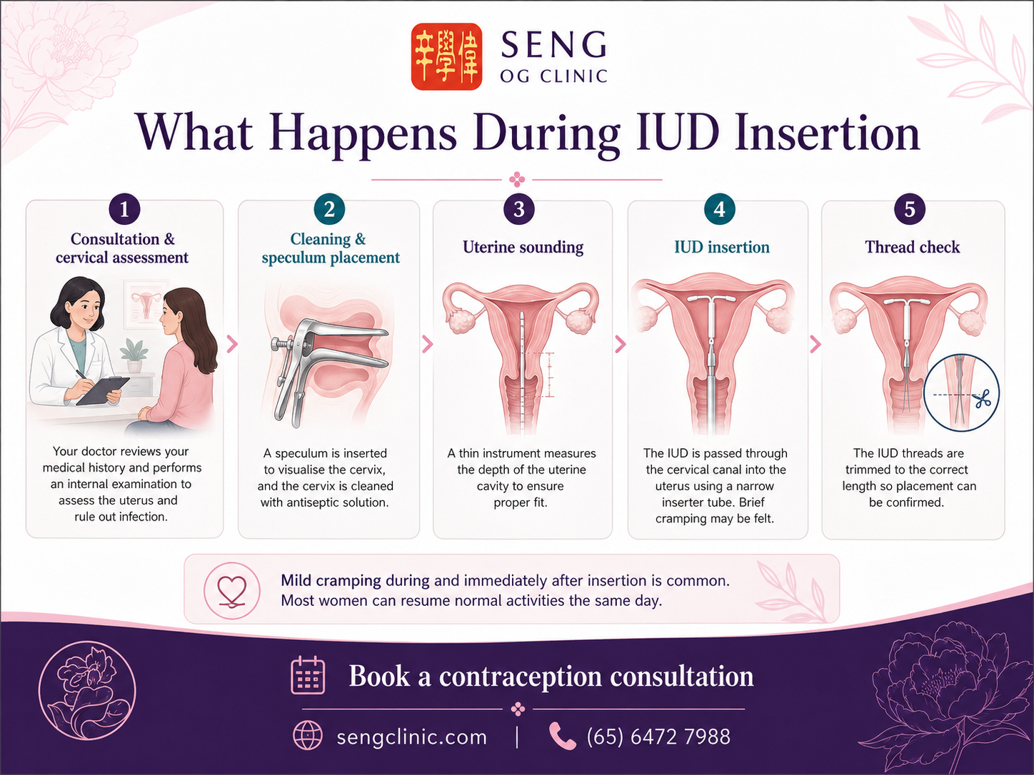 IUD Guide