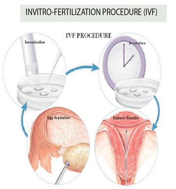 In Vitro Fertilisation (IVF), fertility, fertility doctor