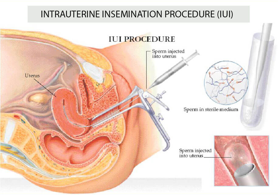 Intrauterine insemination (IUI), obstetrics gynecology infertility, best fertility clinics