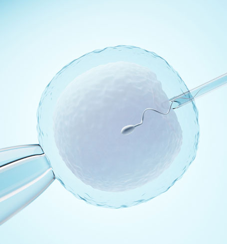 Intracytoplasmic Sperm Injection (ICSI) fertility treatment