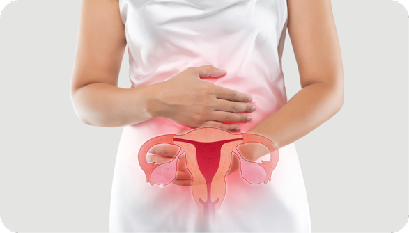 Illustration of endometriosis